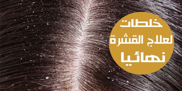 وصفات طبيعية للقضاء علي قشرة الشعر
