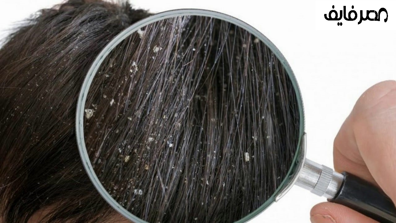 أسباب و علاج قشرة الشعر