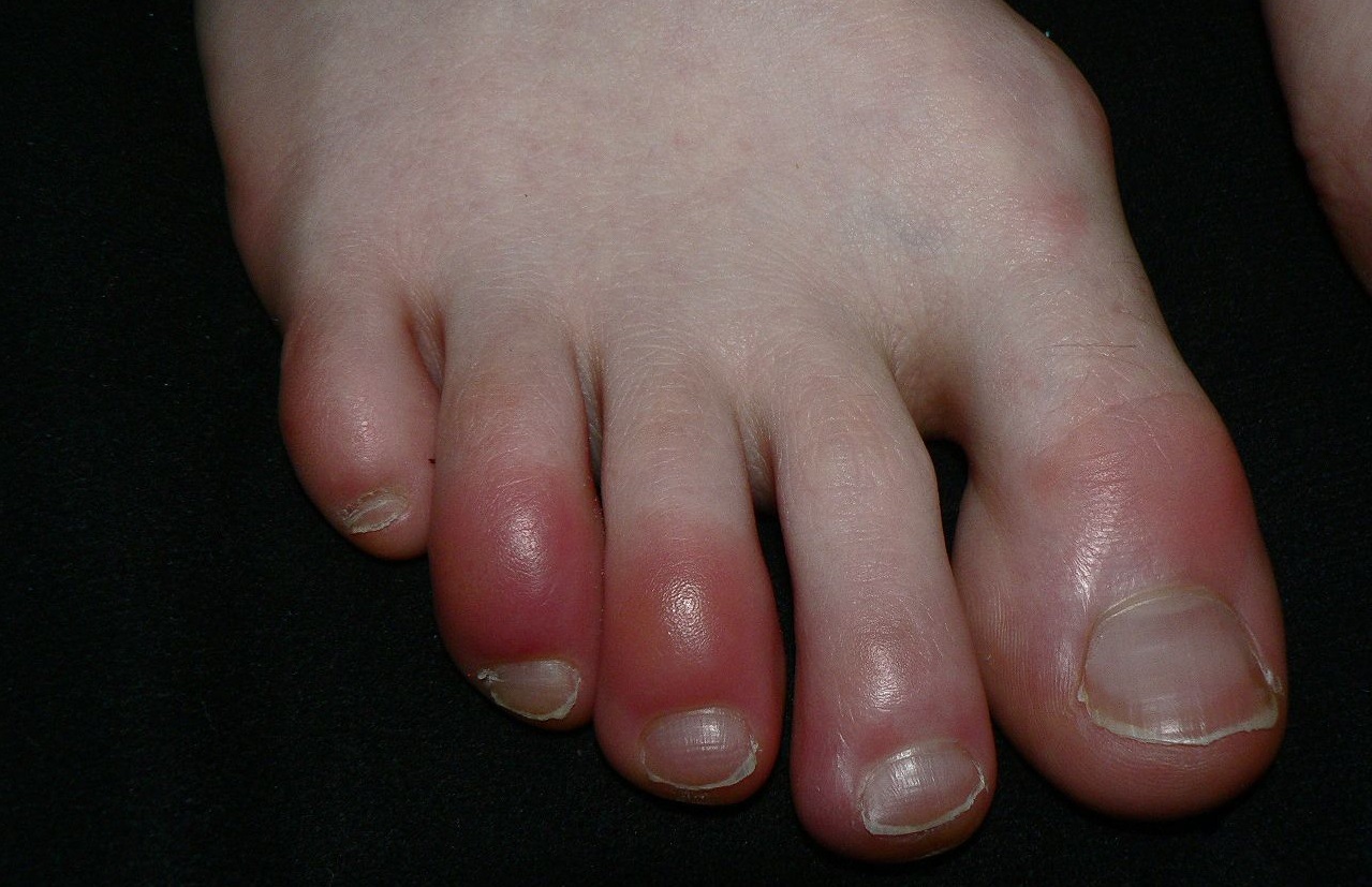مرض “تورم الأصابع الشتائي”.. طرق الوقاية والعلاج