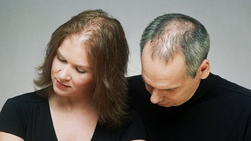 ماهي العلاقة بين تساقط الشعر والصلع؟
