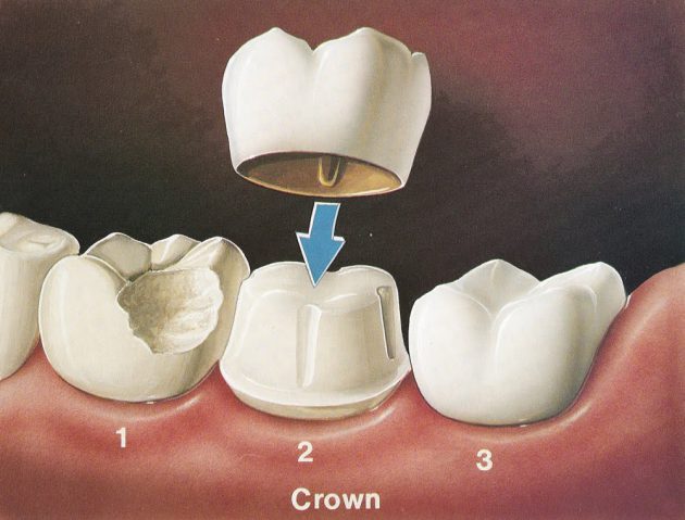 تلبيس الأسنان، طريقة تلبيس الأسنان، حالات تلبيس الأسنان، أهمية تلبيس الأسنان، أضرار تلبيس الأسنان، Dental Crowns