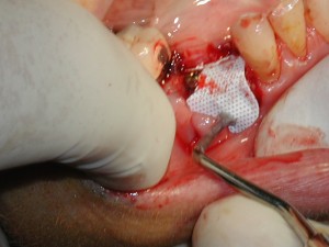 النزيف بعد زراعة الأسنان