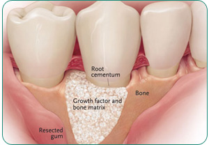 ترقيع العظام و زراعة الأسنان