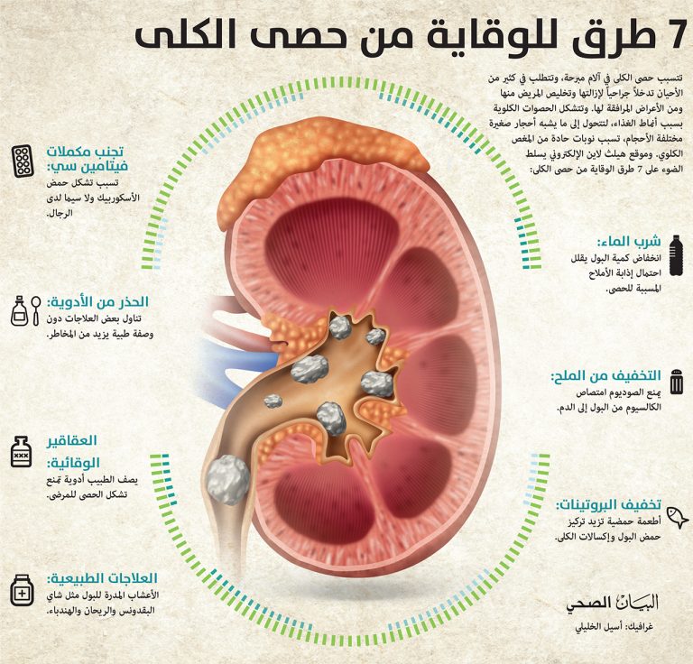 اعراض حصوة المثانة