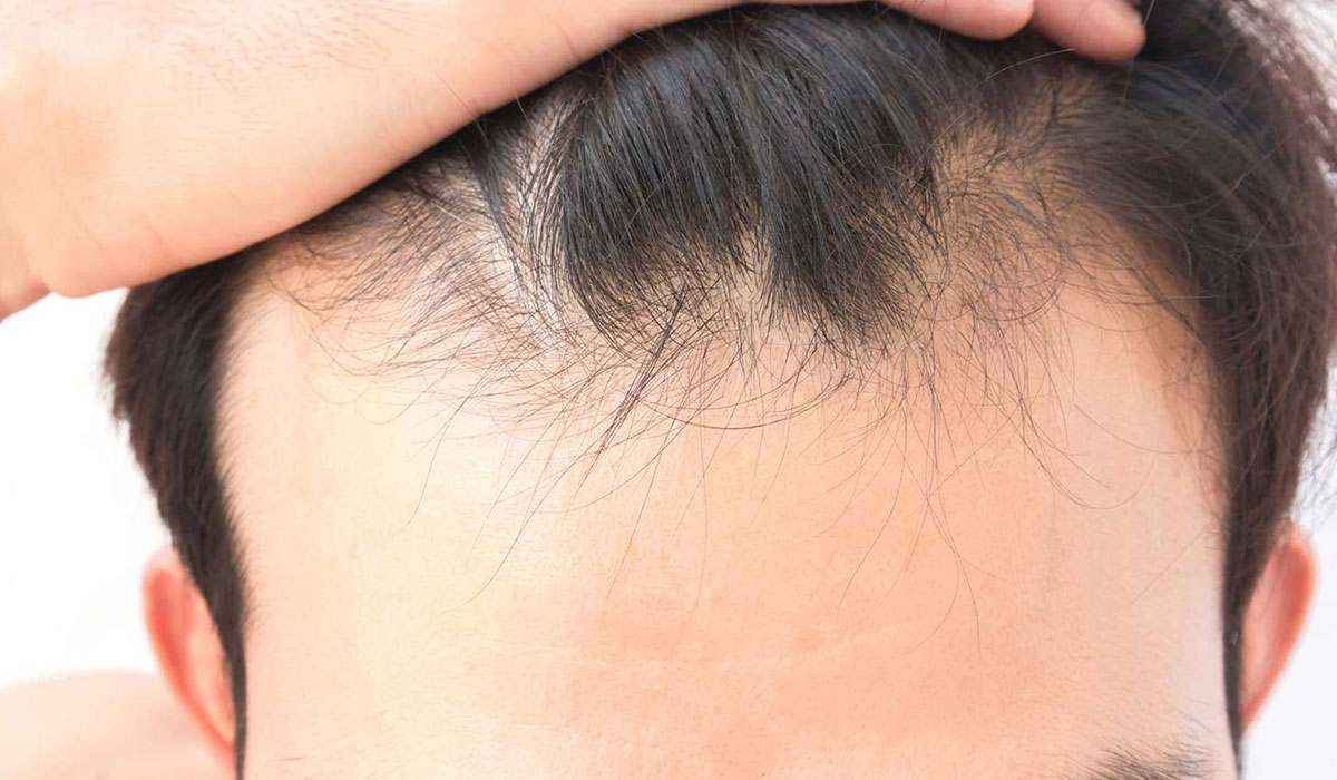 أسباب تساقط الشعر من الأمام وأفضل الوصفات الطبيعية لعلاجه