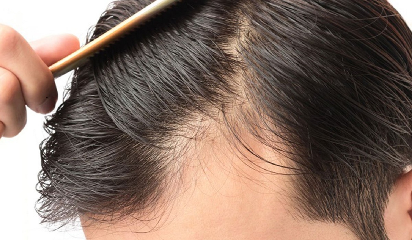 أهم أسباب تساقط الشعر للرجال وظهور الصلع