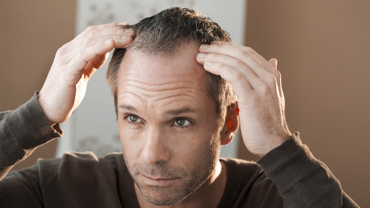 اسباب تساقط الشعر عند الرجال وأهم طرق علاجه 2