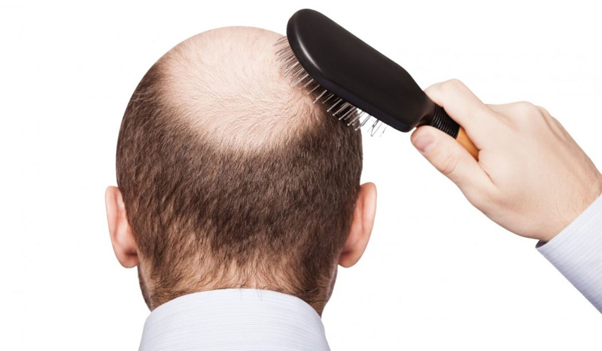 أسباب تساقط الشعر من الأمام وأفضل الوصفات الطبيعية لعلاجه