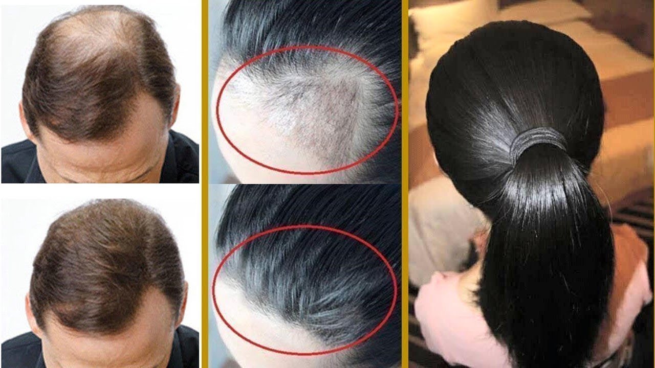 علاج فراغات الشعر والصلع وأفضل الطرق لملئ هذه الفرغات وإعادة إنبات الشعر بها