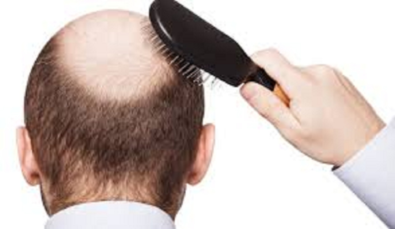منها الوراثة.. 11 سبب يؤدي إلى سقوط الشعر