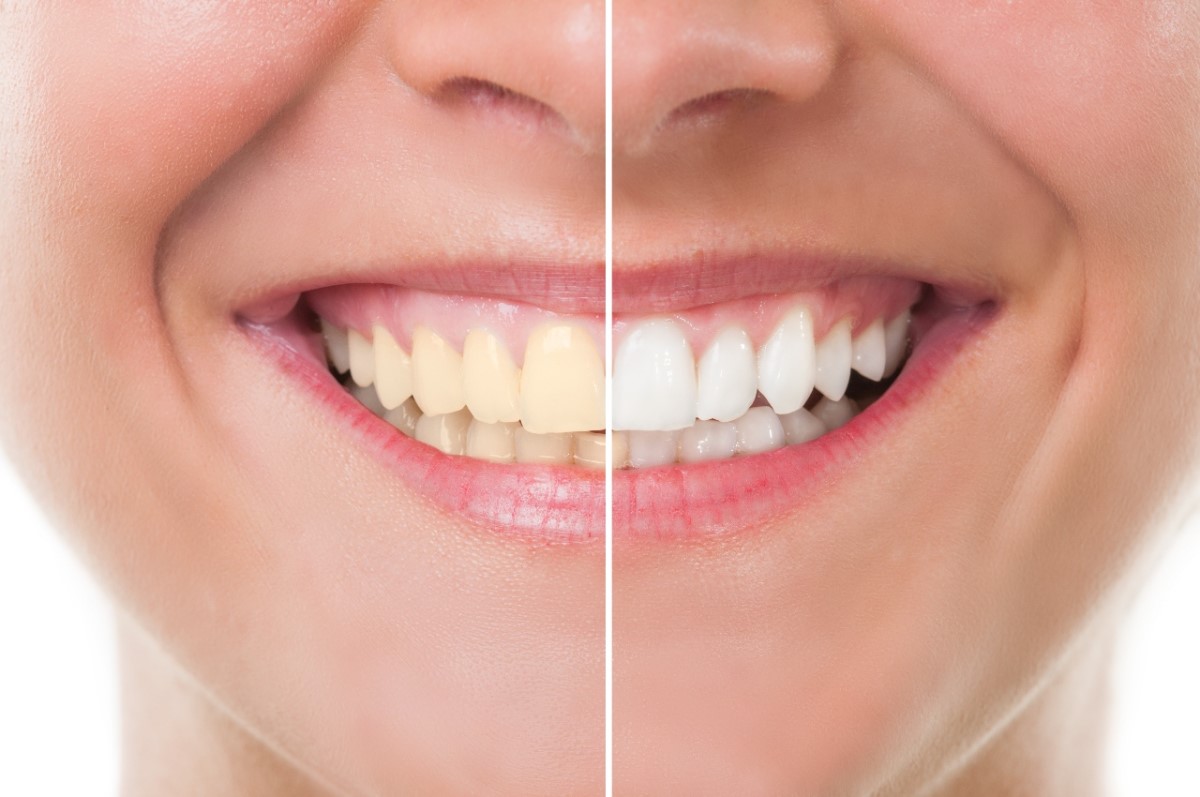 تبييض الأسنان من أول استخدام لهذه الوصفة الطبيعية الممتازة 7