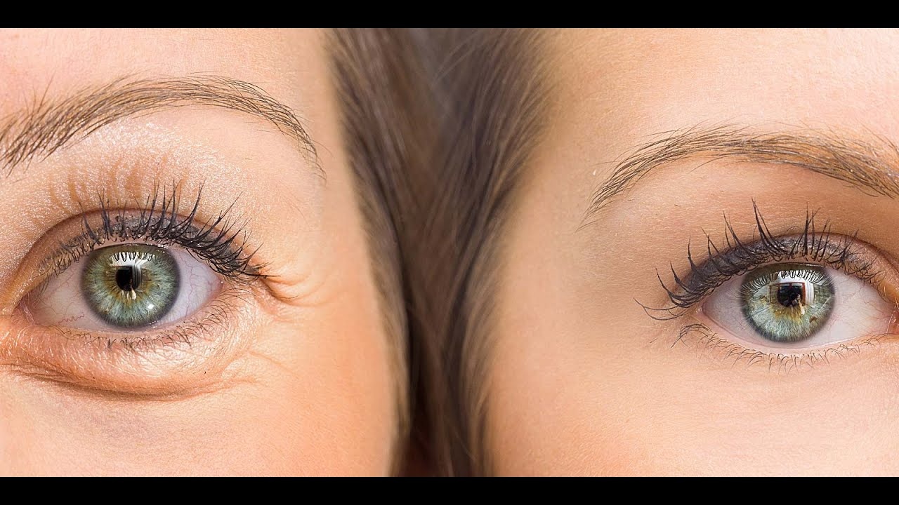 علاج سريع ورخيص للتخلص من العيون المنتفخة والهالات السوداء
