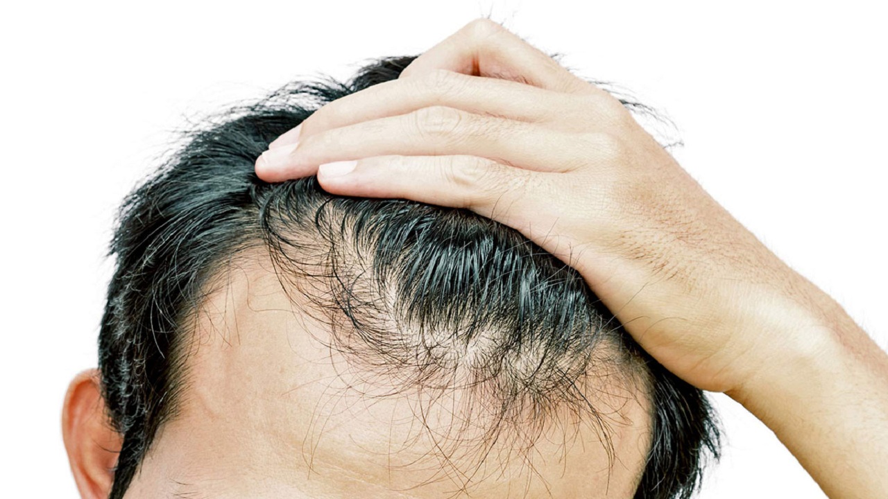 قبل الندم.. وصفة رائعة وقوية لعلاج تساقط الشعر عند الرجال والنساء