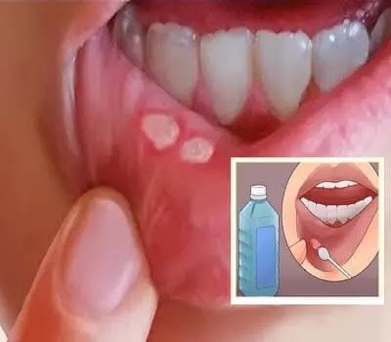 أسباب بثور الفم وأهم الوصفات المنزلية السريعة لعلاجها