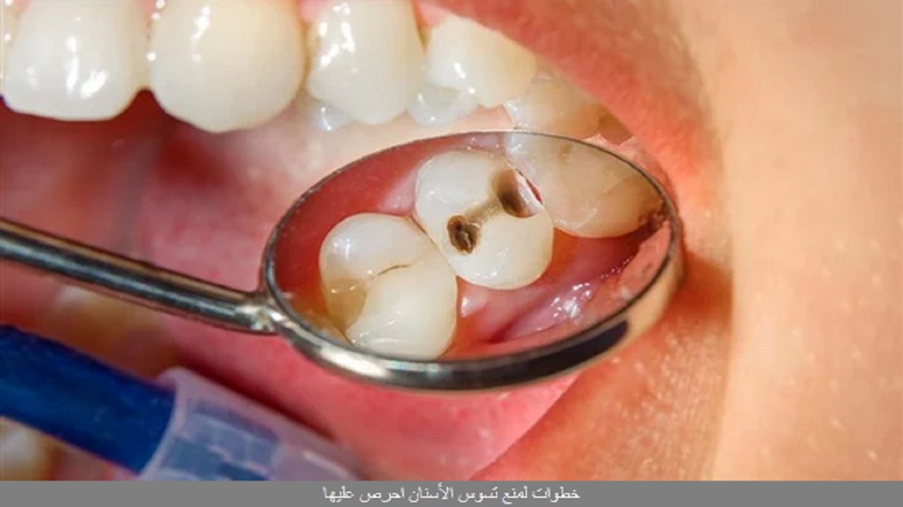 خطوات بسيطة ورائعة لمنع تسوس الأسنان يجب اتباعها