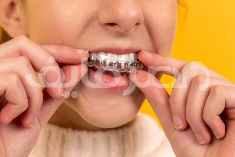 تقويم الاسنان قبل وبعد بالتفصيل.. 5 خطوات لتركيب تقويم الاسنان