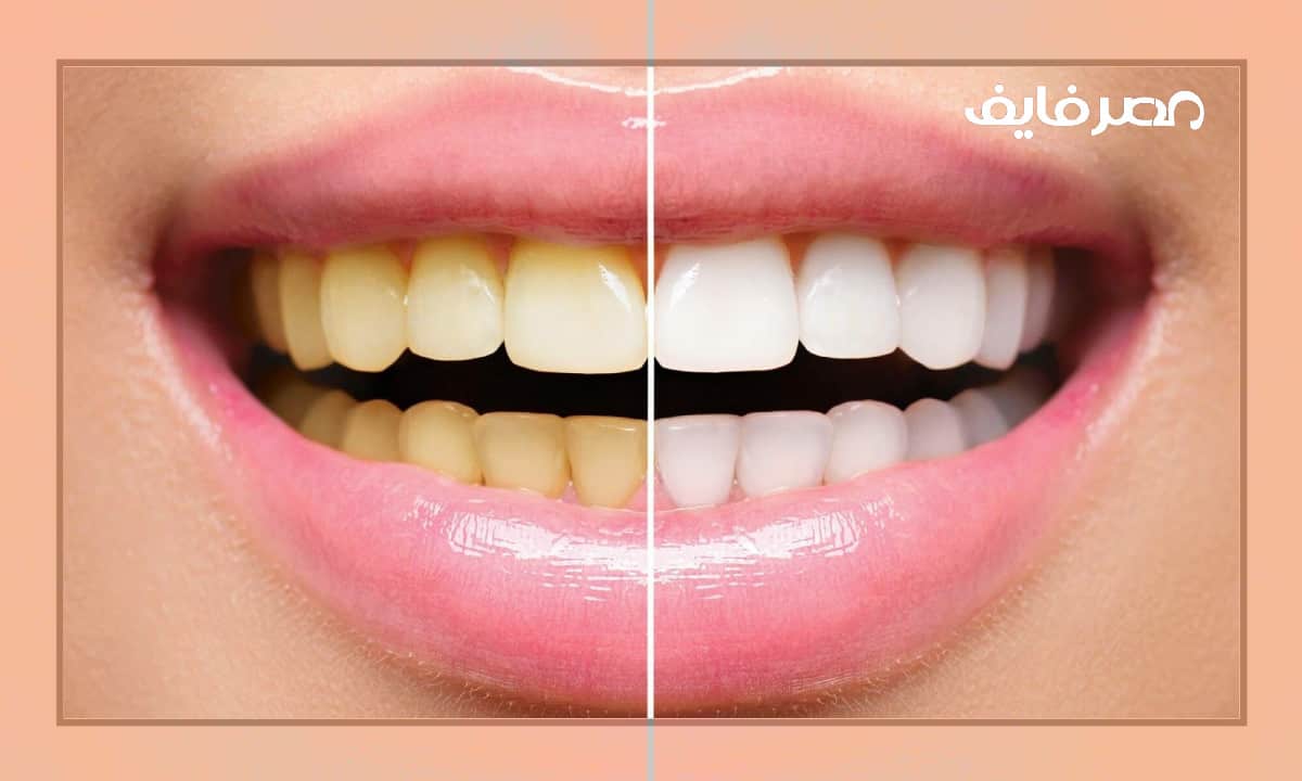 اصفرار الاسنان 10 أسباب لها وطرق العلاج – مصر فايف