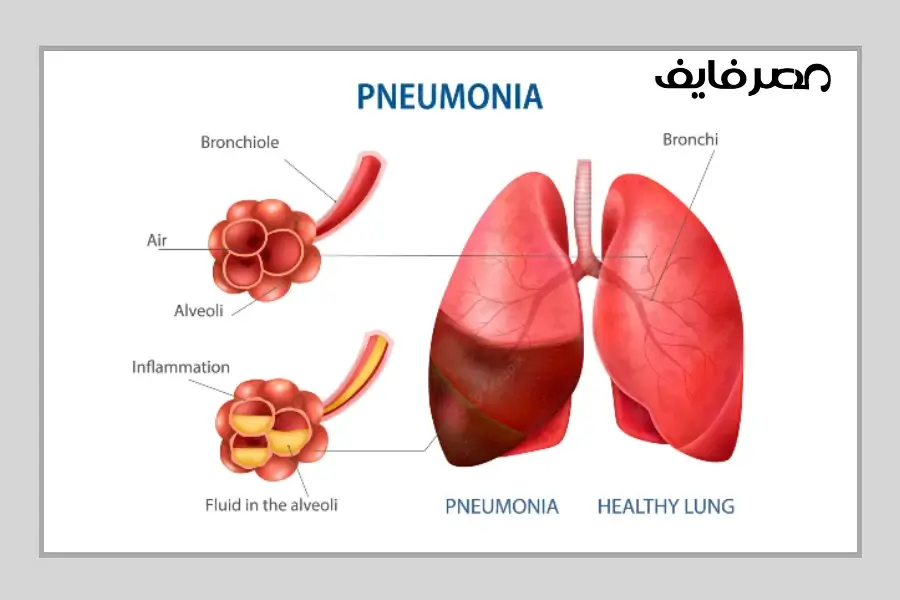 الالتهاب الرئوي أو ما يسمى بذات الرئة (بالإنجليزية: Pneumonia)