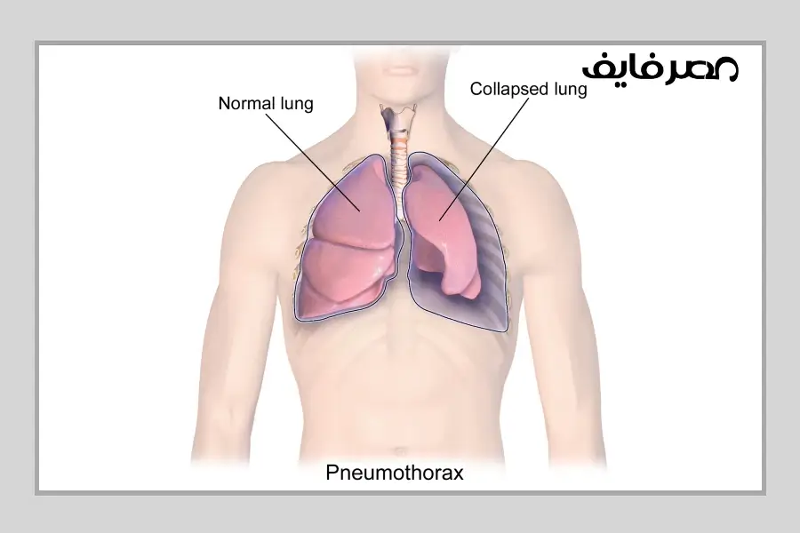 الاسترواح الصدري أو الاسترواح الهوائي الصدري أو انكماش الرئتين أو الصدر المثقوب (بالإنجليزية: Pneumothorax)