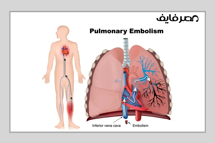 الانصمام الرئوي (بالإنجليزية: Pulmonary embolism)‏