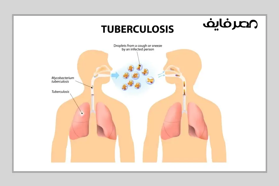 السُّلّ أو الدّرن أو التّدرّن (بالإنجليزية: Tuberculosis)