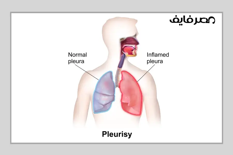 التهاب الجنبة أو ذات الجنب أو الشوصة أو البرسام (بالإنجليزية: pleurisy)‏